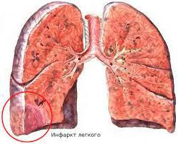 Анализ крови при инфаркте легкого